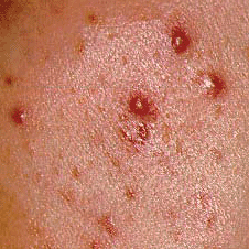 Visible Signs Of Acne: papules and pustules